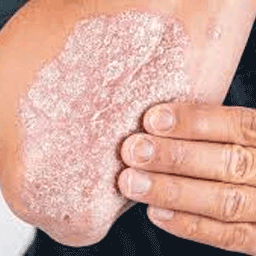 skin-disease img